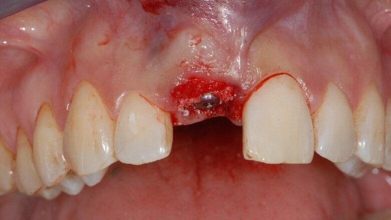 Impianto post-estrattivo e provvisorio immediato su incisivo centrale superiore di destra