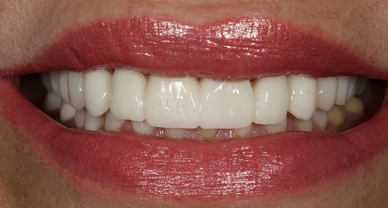 Fig. 19: Frontal view of the patient’s full smile.