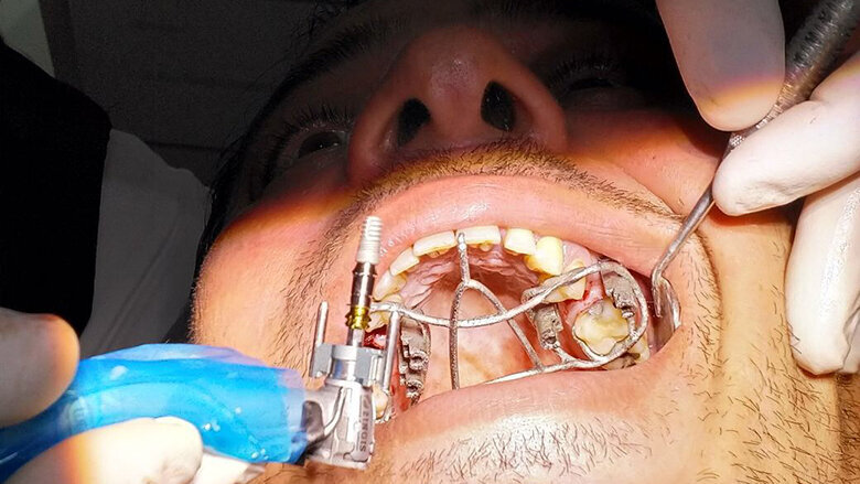 Middle East’s First Metal 3D Printed Surgical Guide