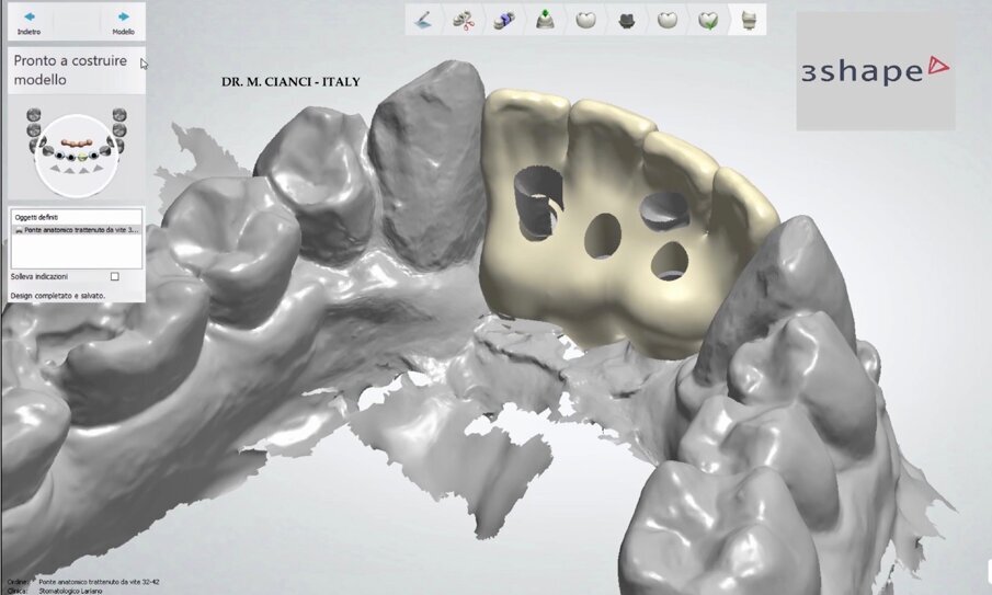 Fig. 10 - Fase CAD 3Shape Dental Designer (provvisori).
