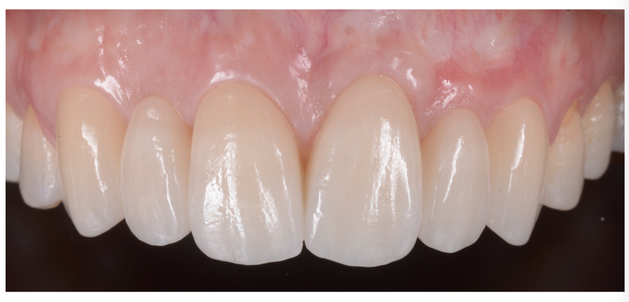 Fig. 29_Lavoro finito con condizionamento congruente al provvisorio.