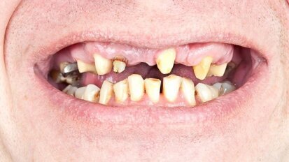 Polacy nie uzupełniają swoich ubytków