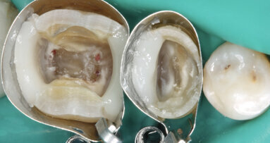 La cavité d’accès en endodontie : les trois principes pour un résultat prédictible dans les cas complexes