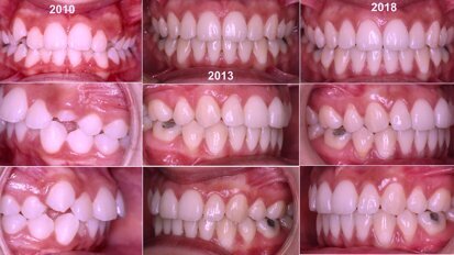 ¿Extracción o Expansión en Ortodoncia? (5)