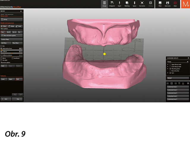 Stavění zubů (přirozený set zubů ze zubní knihovny Heroes Collection firmy Zirkonzahn; tvar zubů „Aida“). Zobrazení kořenových částí zvolených zubů dovoluje v CAD programu jejich anatomicky správné umístění…