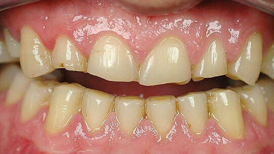 Riabilitazioni full arch con preparazioni microinvasive