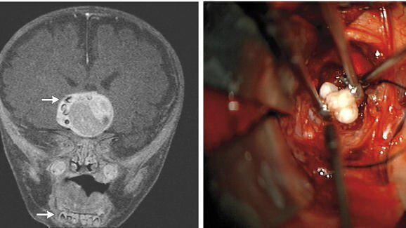 Cirurgiões descobrem dentes no tumor de cabeça de um bebê