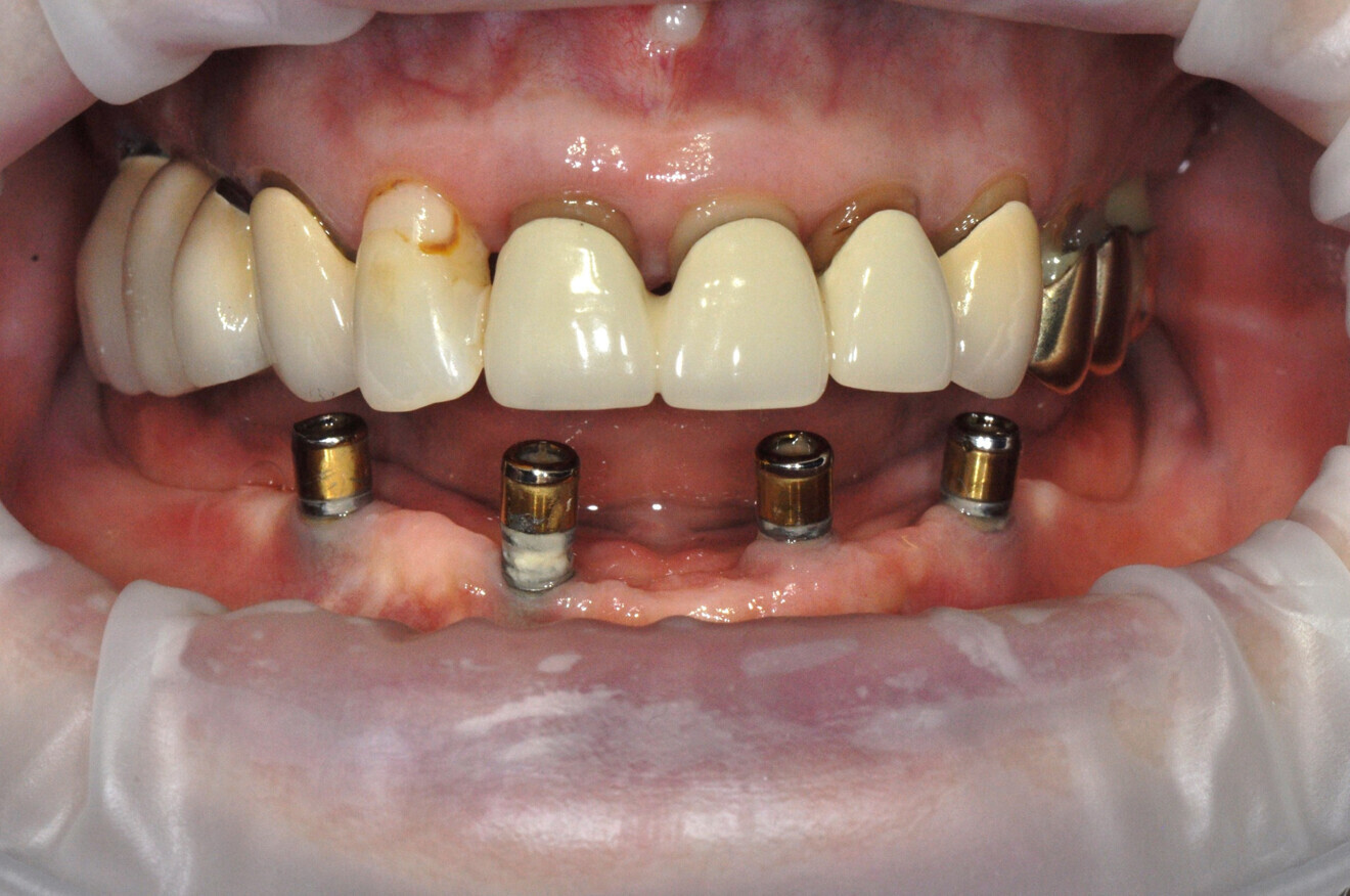 Before Guided Biofilm Therapy.