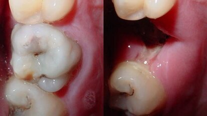 Nieuw mondwater voorkomt tandbederf