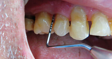 L’utilizzo della terapia fotodinamica HELBO  nella parodontopatia