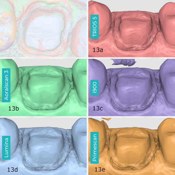 Figs. 13a–e: Buccal and lingual margins on the scans. TRIOS 5 (a). Aoralscan 3 (b). Medit i900 (c). ITero Lumina (d). CEREC Primescan (e).