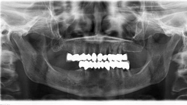 Impianti in paziente con terapia farmacologica per infiammazione renale e inizio di osteoartrosi: cortisoni a lungo termine