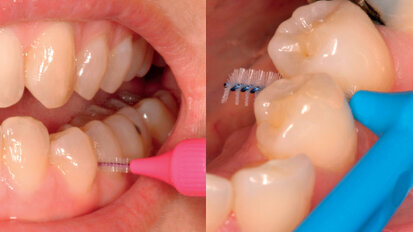 La pulizia interdentale su basi scientifiche