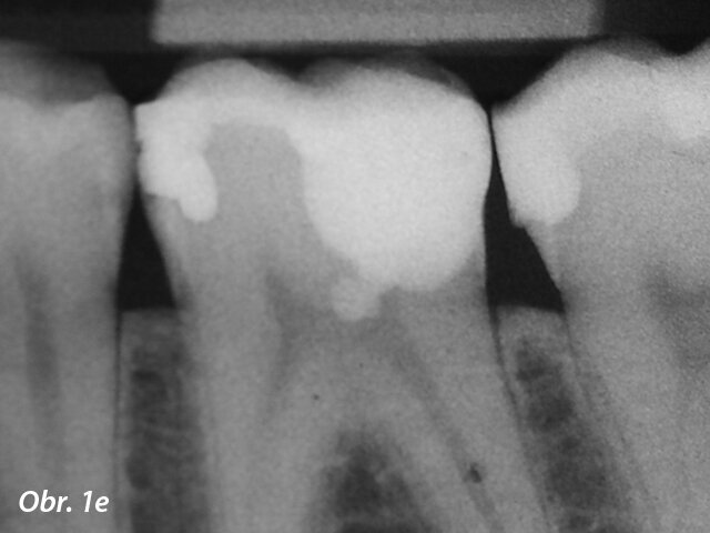 Postoperační RTG zobrazující překrytí pulpy s MTA