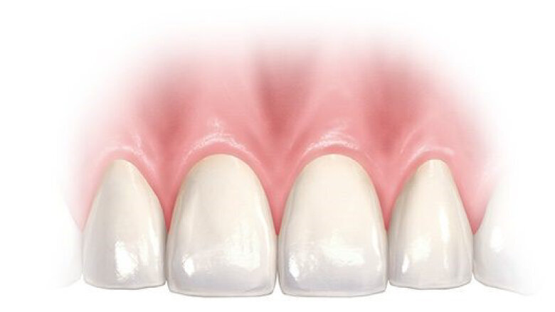 Okamžité zavedení implantátu