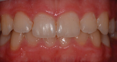 Opportuni scenari di prevenzione in odontoiatria pediatrica: case report