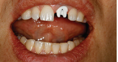 Inovativní technologie ve zhotovování náhrad na implantáty – budoucnost je tady již dnes