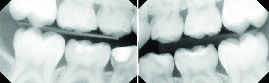 Figs. 4 (a & b). Patient LT, who was dentally anxious, also had dental caries which the above bitewings show.
