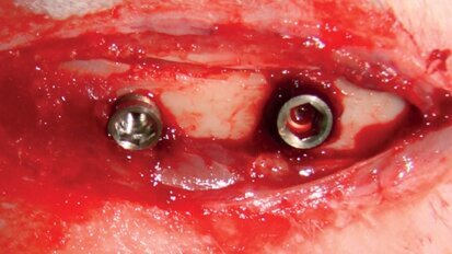 Histological and biomechanical effects of implant surfaces sandblasted with titanium dioxide microparticles: An experimental study using the rabbit tibia model Histological and biomechanical effects of implant surfaces sandblasted with titanium dioxide microparticles: An experimental study using the rabbit tibia model