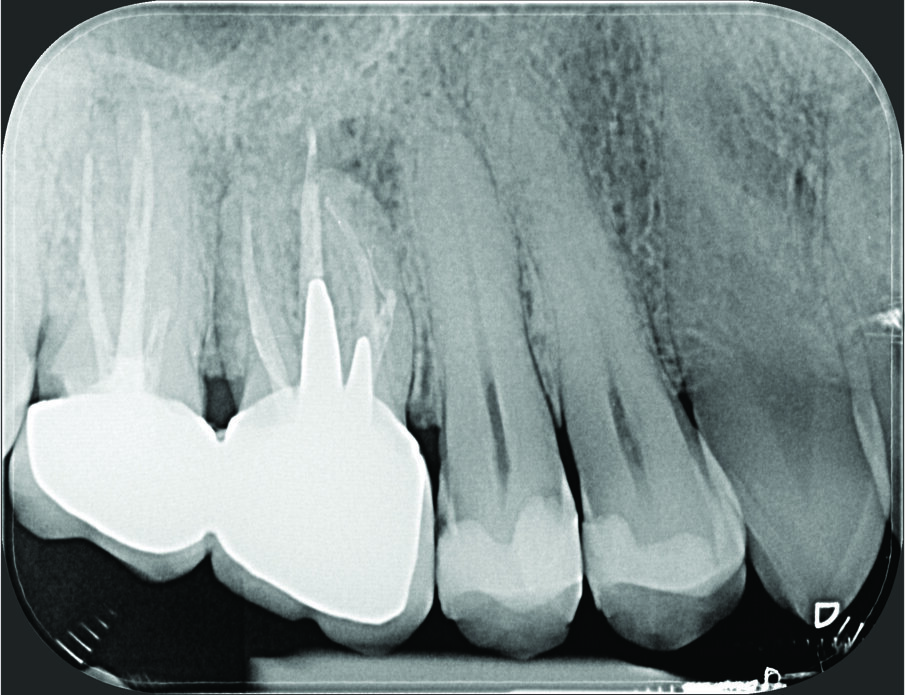 Fig. 1a - Il paziente è stato inviato per la terapia chirurgica della radice mesiovestibolare del primo molare superiore di destra.