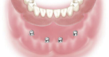 Henry Schein to distribute Dentatus