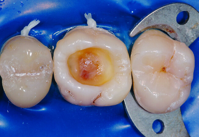 Fig. 16 : Le curetage de la lésion carieuse est réalisé sous champ opératoire afin d’éviter toute contamination salivaire de la plaie dentinaire. 