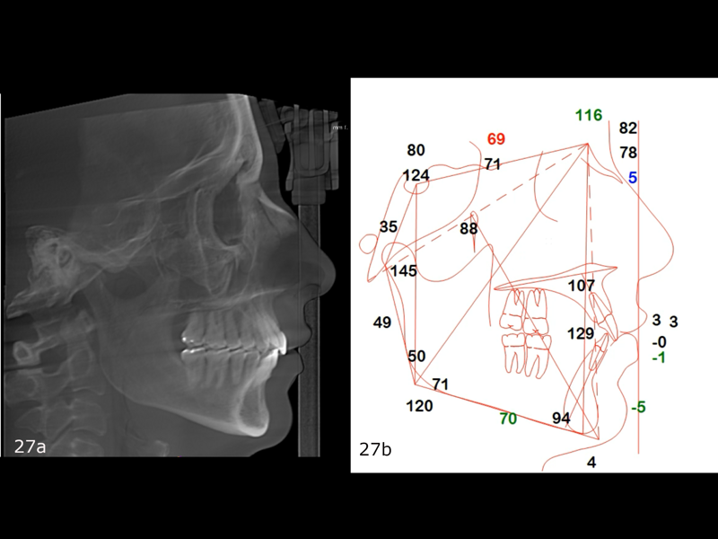 Figs. 27a & b: (a) Post-treatment cephalometric radiograph and (b) tracing.