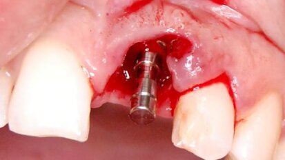 Implantacja natychmiastowa i kształtowanie estetyki różowo-białej – opis przypadku