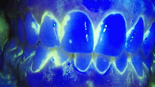 Effetto barriera dei sigillanti