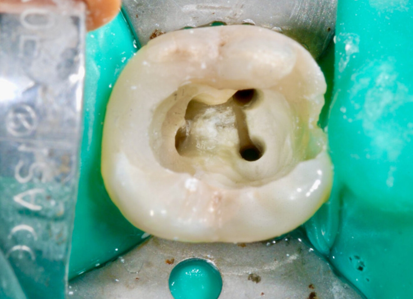 Fig. 23 : Cavité d’accès correctement restaurée et canaux mis en forme.