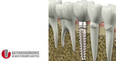 Aktionsbündnis gegen Periimplantitis