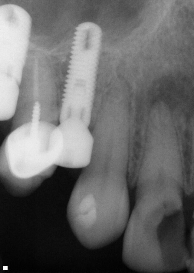 Fig. 10: Tooth 7 presented with large portion of the MBLI missing on tooth with pulpal involvement as evidenced by a moderate periapical area.