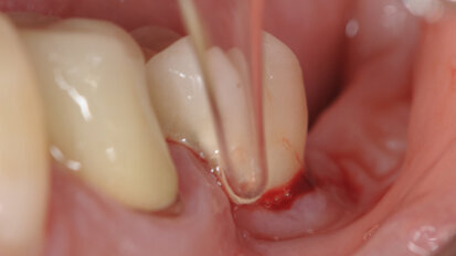 L’ozonoterapia nella gestione della Perimplantite: case report