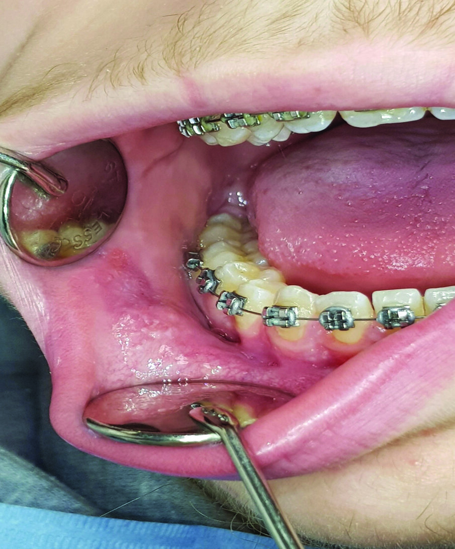 Fig. 3 - Lesioni ulcerative provocate dallo strofinamento della mucosa buccale con i bracket in corrispondenza dei denti 43-44-45.