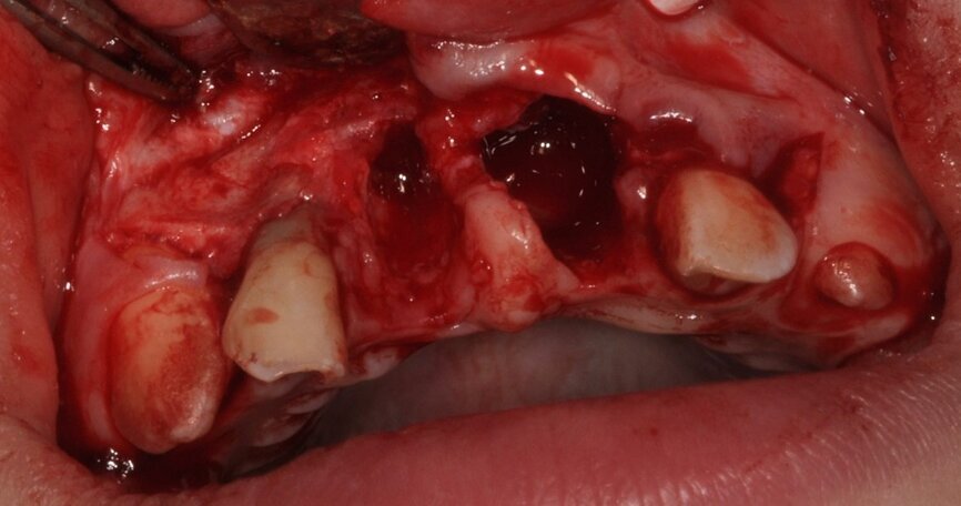 Ryc. 4¬_Stan miejscowy po ekstrakcji i ablacji kości.