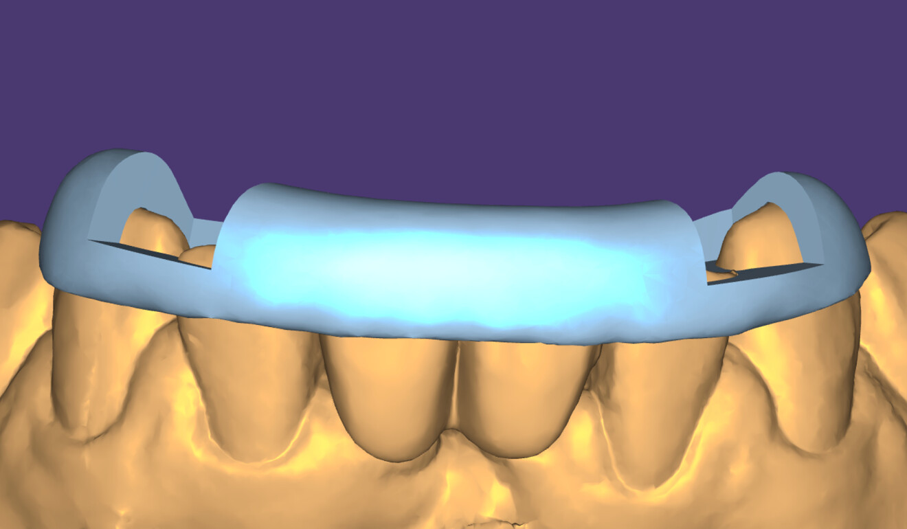 Fig. 6: Repositioning key designed using exocad software (via the design4me platform).