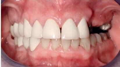 Konstrukcja mostu w odcinku przednim żuchwy