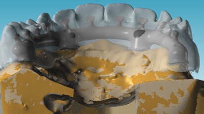 Gestione di un caso Full Arch con flusso digitale