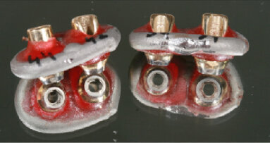 Náhrada nesená implantáty s využitím technologie teleskopů. Liviu Steier hovoří o hybridních protézách nesených implantáty