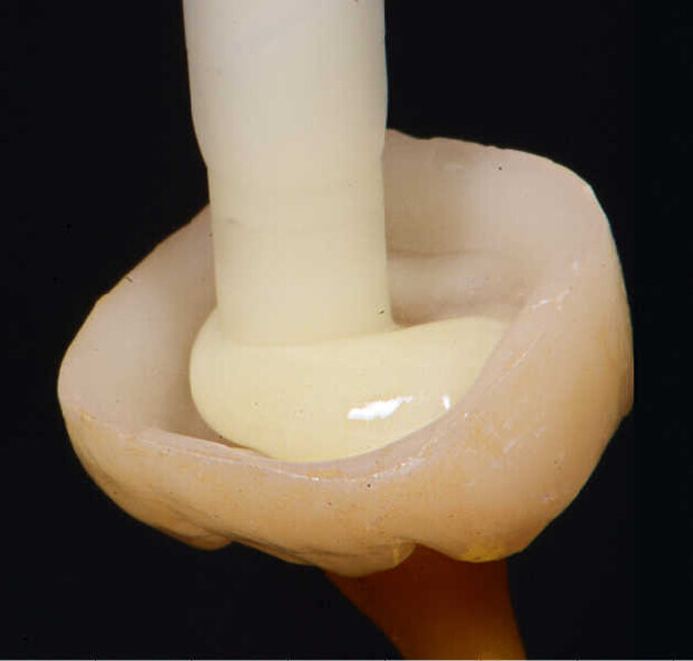 Fig. 7. Aplicación del composite de cementación Variolink Esthetic DC en la corona.