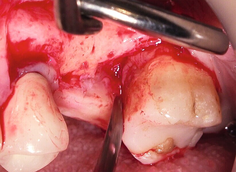 Fig. 37 : Exposition du défaut parodontal (face mésiale de la deuxième molaire). 