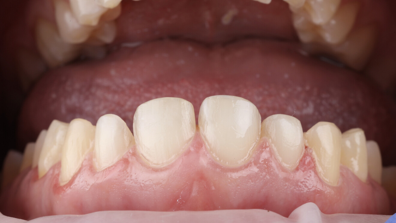 Fig. 6c: Tooth surfaces after application of the bonding agent.