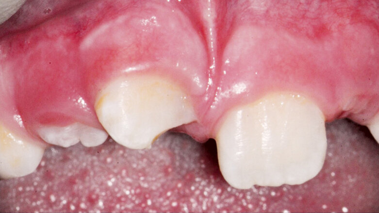 Endodontické ošetření zubů s nedokončeným vývojem kořene