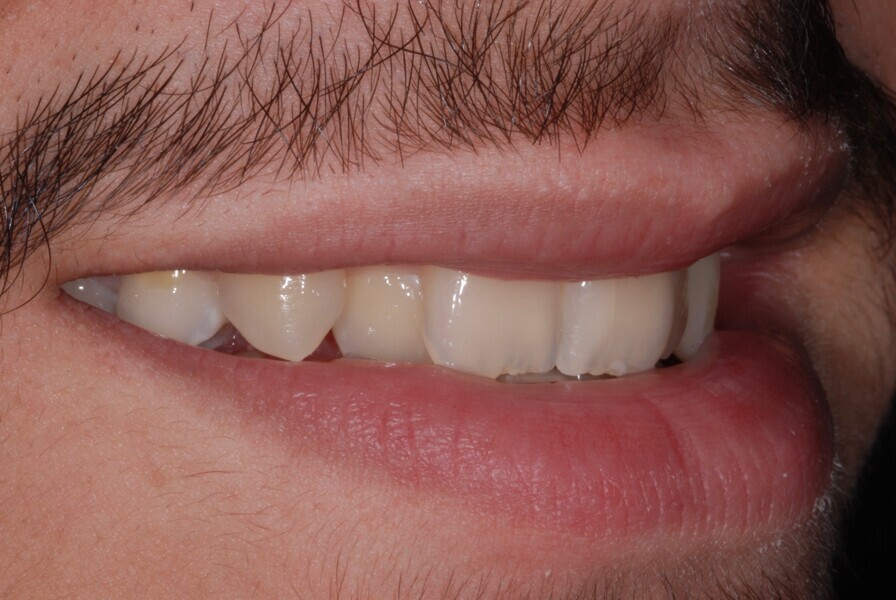 Fig. 29: Smile right side view before treatment.