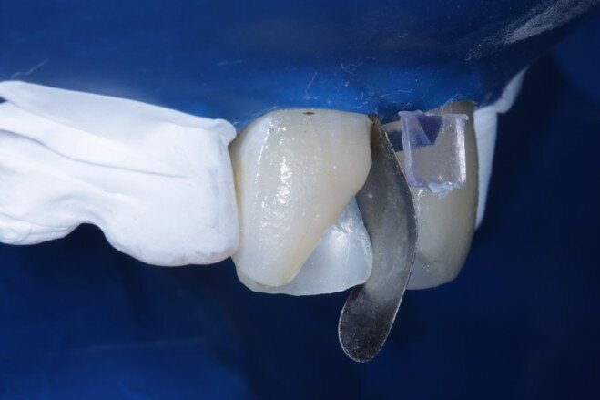 Fig 9 Sectional matrix placed vertically