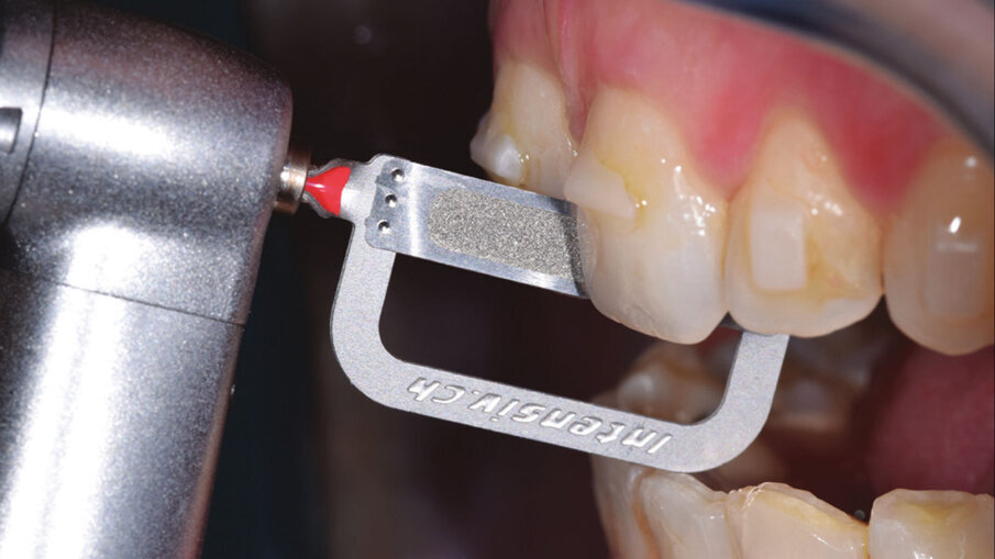 Figg. 7a-7e_Step intermedio. Lo stripping è stato eseguito con le nuove Orthostrips “Central” Intensiv. Una corretta procedura di riduzione interprossimale ci permette di recuperare spazio in arcata per ottenere la risoluzione completa dell’affollamento dentale e delle rotazioni presenti.