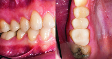Une approche minimalement invasive respectueuse des principes biomécaniques des dents