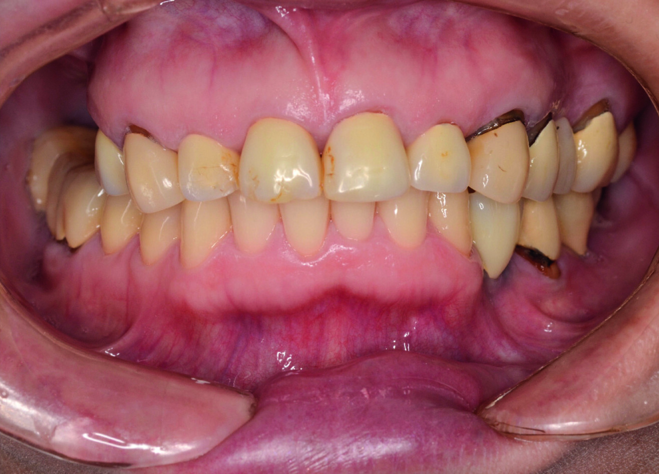 Fig. 2 b : Situation initiale avec péri-implantite à un stade avancé.
