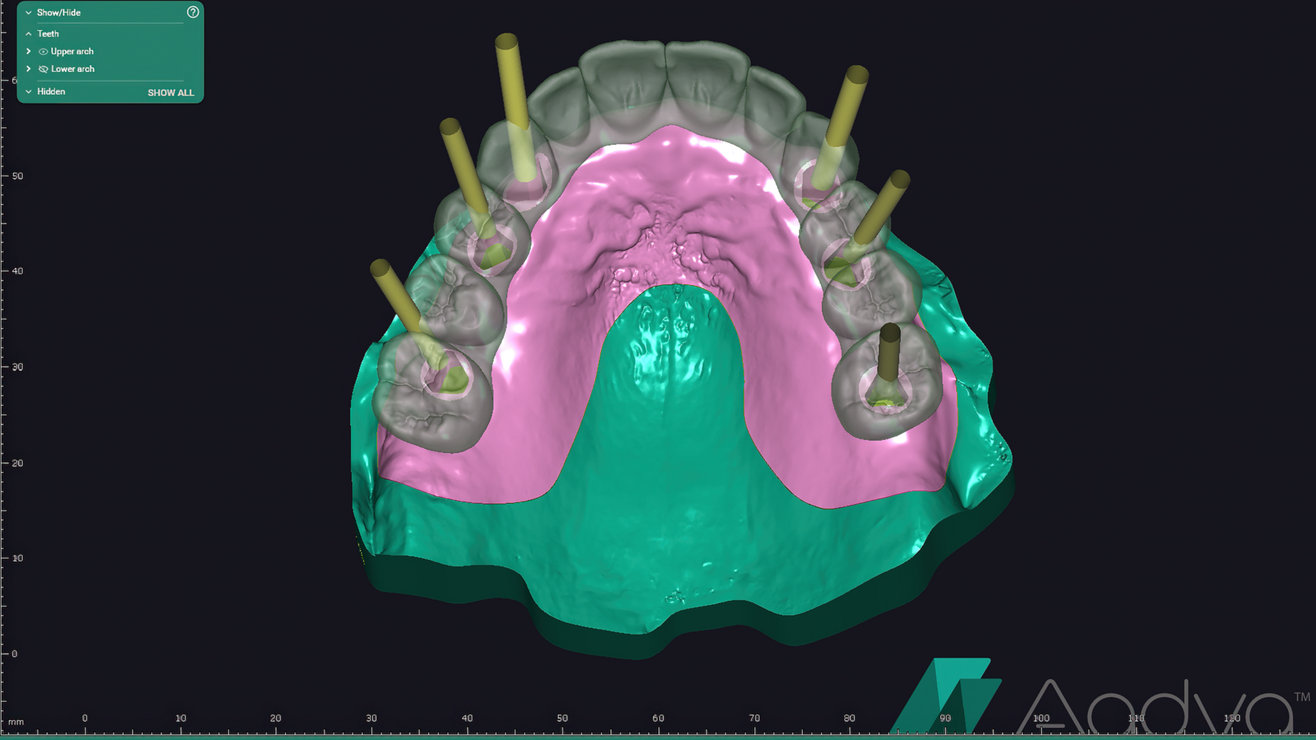 Fabrication of a long-term prototype to develop and sculpt anterior gingival tissue