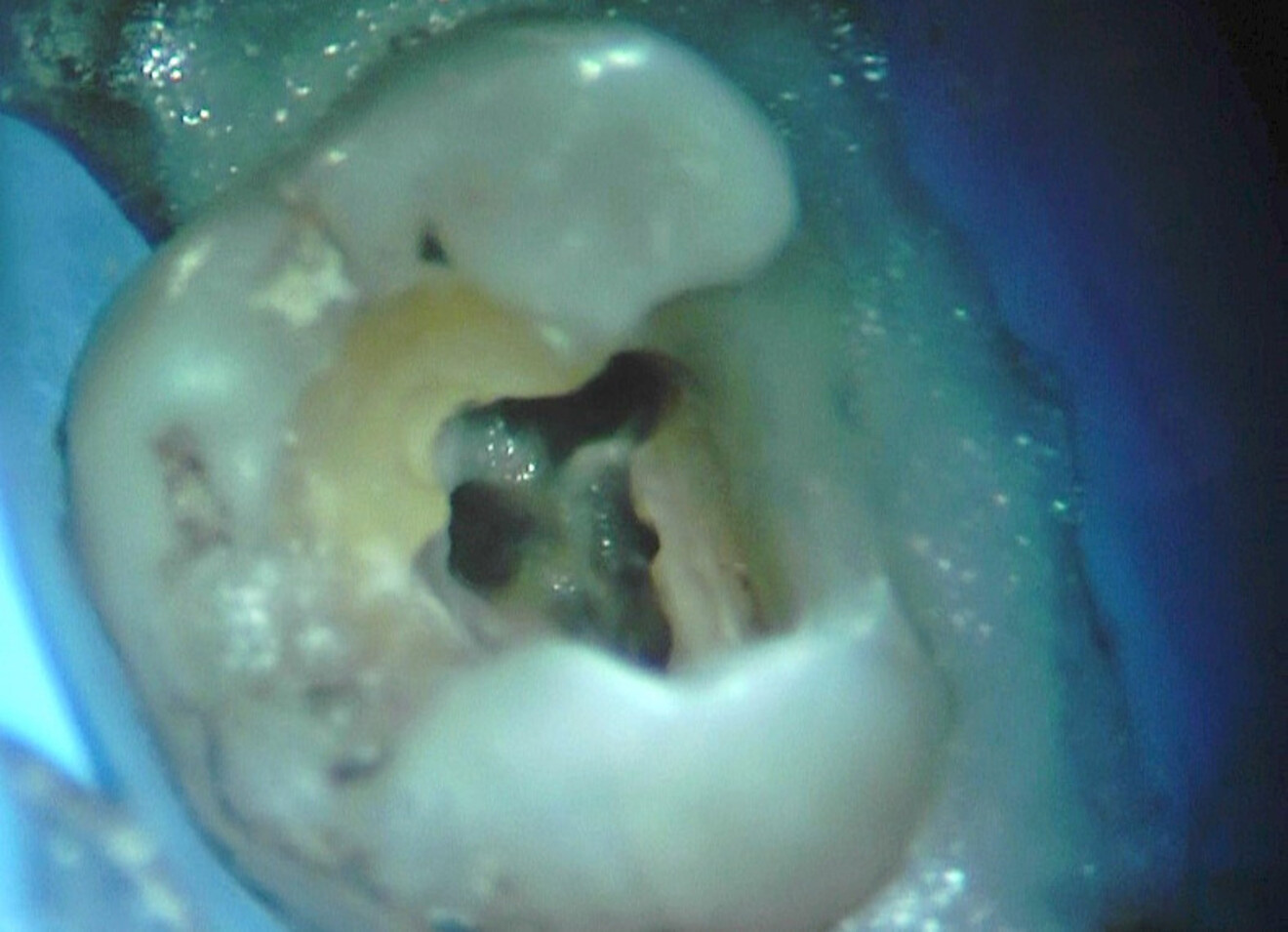 Fig. 15 : Canal MV et second canal MV mis en forme et nettoyés, prêts pour le scellement endodontique.